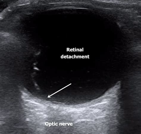 Intern Ultrasound Of The Month Posterior Vitreous Detachment