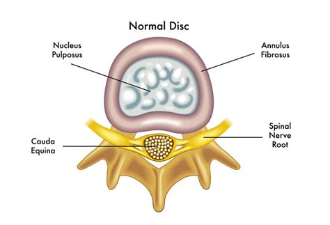 Bulging Disc L4 L5 2023 Guide To Symptoms And Treatment