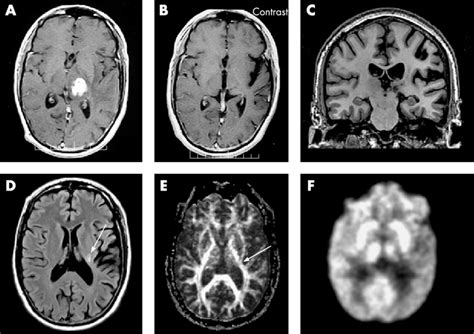 Serial Mri Findings In A Case Of A Resolving Left Thalamic Tuberculoma
