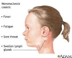 Most often, the lymph node enlargement behind the ear occurs due to sars or otitis. swollen lymph nodes behind ear - Google Search | Guillain ...
