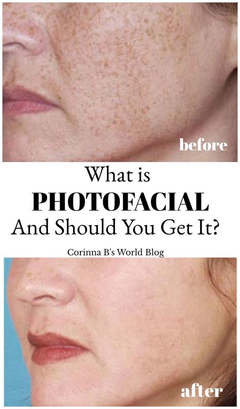 What Is Photofacial And When Should You Have One Corinna Bs World