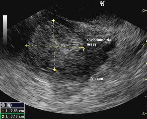 36 Uterine Cancer Ultrasound Images