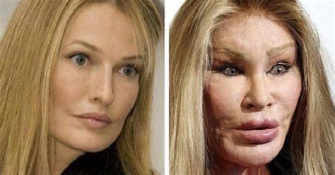 10 Worst Celebrity Plastic Surgery Gone Wrong