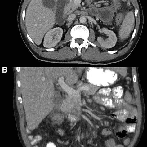 Ct Scan Of The Upper Abdomen After Iodine Contrast Injection Showing