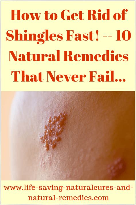 At Last A Natural Cure For Shingles Has Been Discovered Cure For