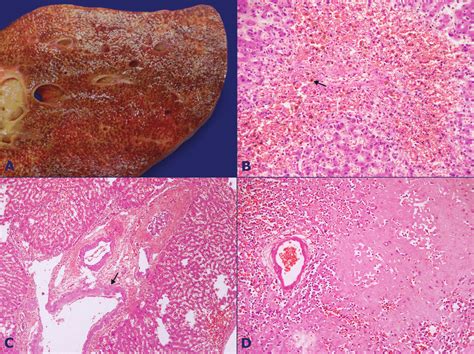 The right lobe of liver is larger than the left lobe of liver. A-Liver segment showing the classical aspect of "nutmeg ...