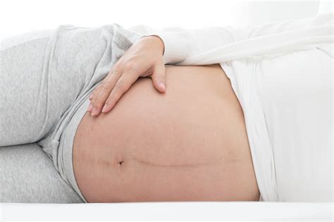 Black Line On Belly Of Pregnant Women Pregnancy Line Or Linea Nigra