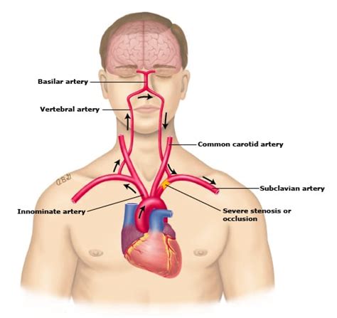 Subclavian Steal Syndrome Neuropedia
