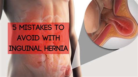 Last updated on march 18, 2021 by surekha. 5 Mistakes To Avoid With An Inguinal Hernia - YouTube