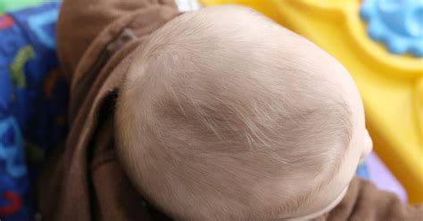 How To Treat Dry Scalp In Babies Livestrongcom