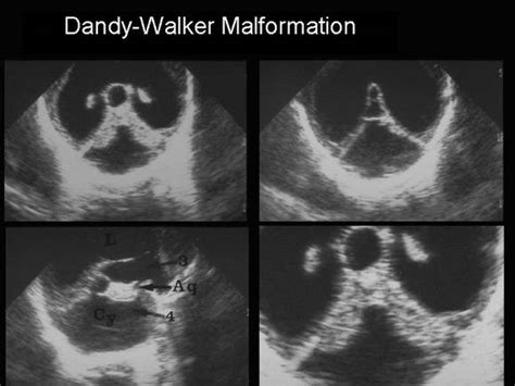 Ultrasound Of Dandy Walker Malformation