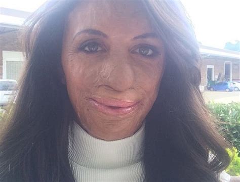 Turia Pitt S New Nose Surgery Wasn T Without Complications