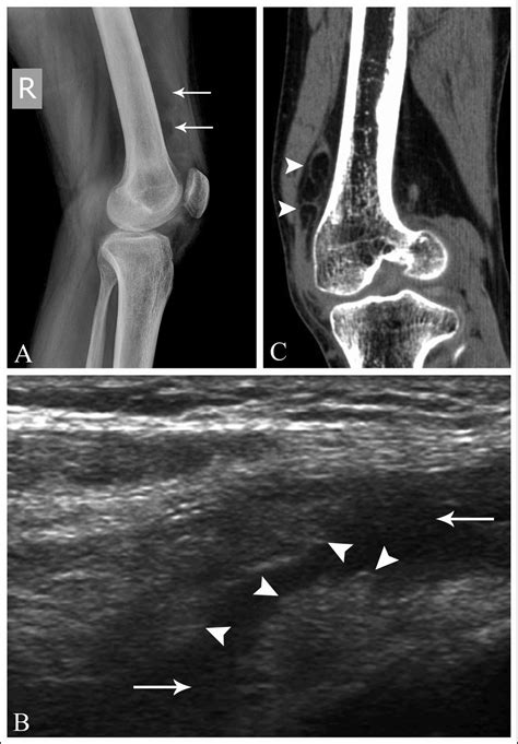 Imaging Findings In Lipoma Arborescens BMJ Case Reports