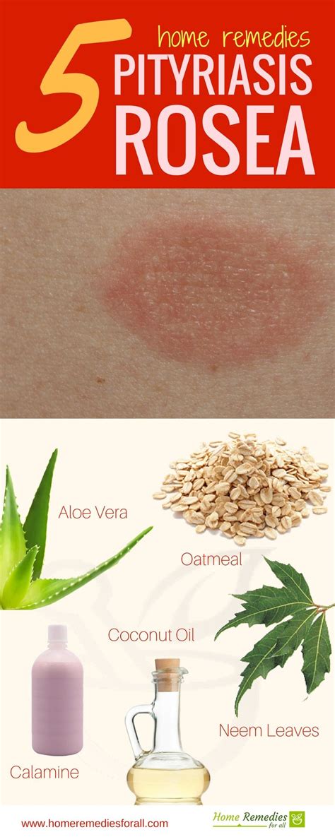 the best 11 pityriasis rosea treatment at home learnearnart