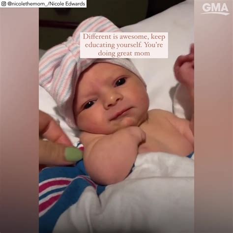 Mom Shares Message One Year After Her Daughter Was Born With A Limb