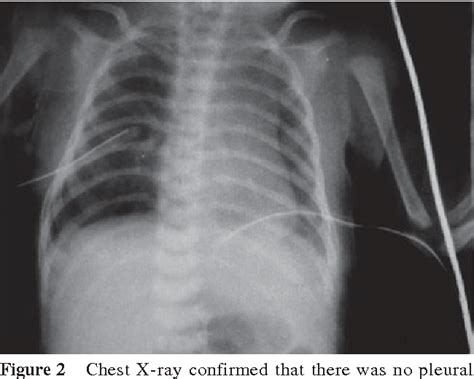Figure 2 From Treatment Of Idiopathic Congenital Chylothorax In