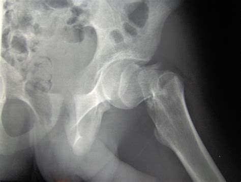Hip Fracture Surgery Types