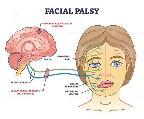 Facial Palsy And Muscles Weakness Because Of Nerve Damage Outline Diagram Labeled Educational
