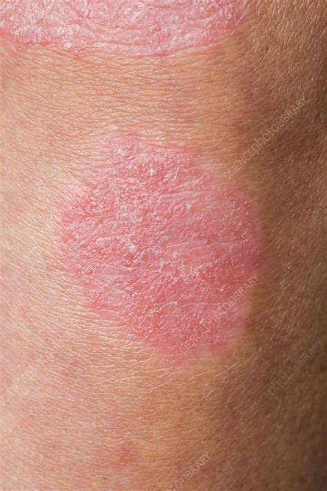 Psoriasis Stock Image C0350996 Science Photo Library