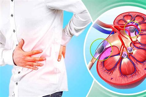 How To Get Immediate Relief From Kidney Stone Pain Simplicity