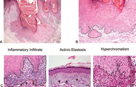 Keratoacanthoma Histological Features A Hande 40u00d7 Low Power