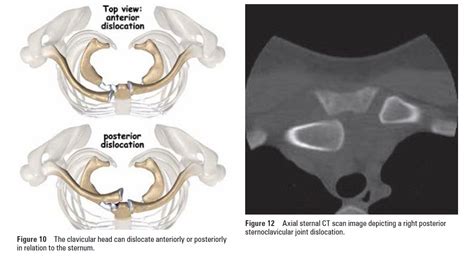Sternoclavicular Joint Disorders Physiopedia