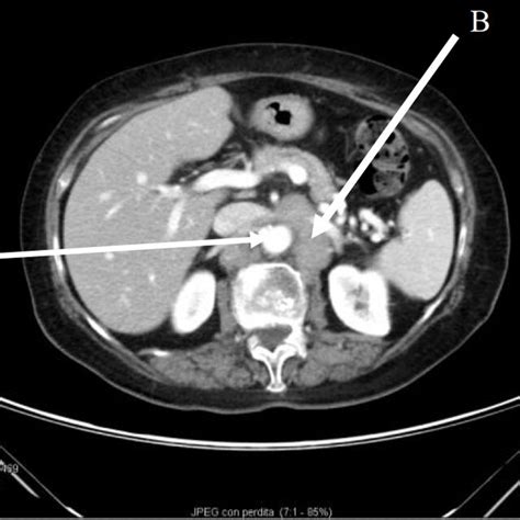 Abdomen Ct Scan Image Showing A Normal Size Aorta A And Enlarged