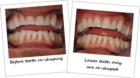 Teeth Shaping