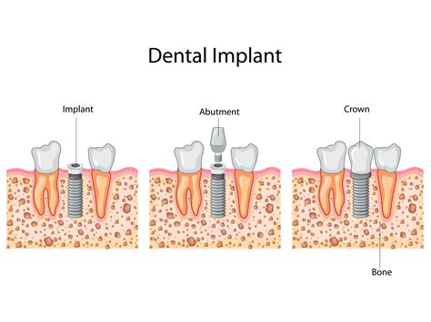 Single Dental Implants In Missoula Mt Meng Dentistry