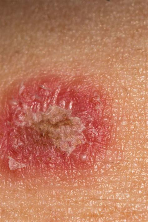 Antibacterial Anti Itch Psoriasis Cream Dermatiti Eczematoid Hand Tinea