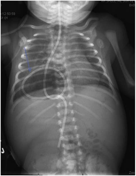 Nasogastric Tube In The Right Hemithorax Where Is It The Journal Of