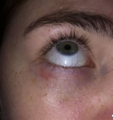 What Are These Bumps Under My Eyes How Can I Treat Them Acne