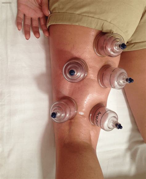 Cupping Livewell Health And Physiotherapy