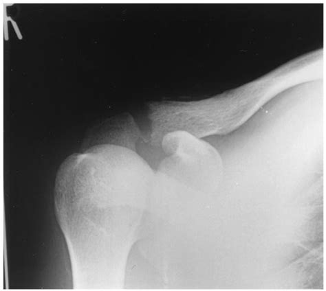 A Case Of Post Traumatic Osteolysis Of The Distal Clavicle Histologic