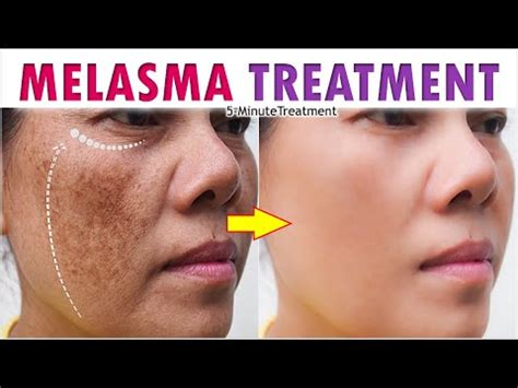 How to cure melasma from the inside home remedies. How To Treat MELASMA Spots | Facial Pigmentation Treatment ...