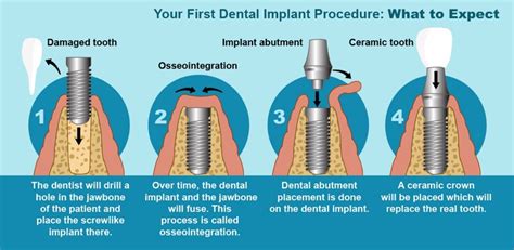 Dental Implant Procedure Ladys Island Sc Beaufort Dentist