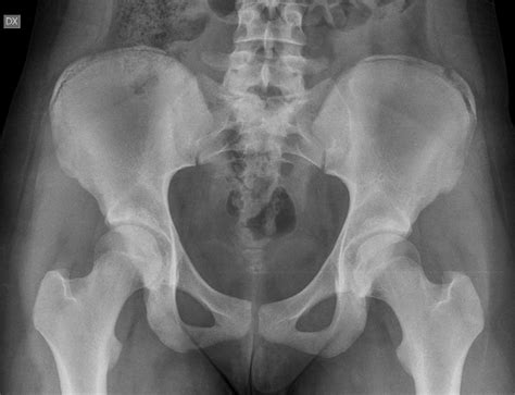 An Anterior To Posterior Ap X Ray Of The Pelvis Demonstrated An