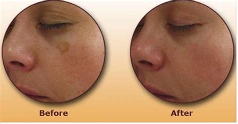 Age Spots Also Known As Liver Spots Are Flat Tan Brown Or Black Spots