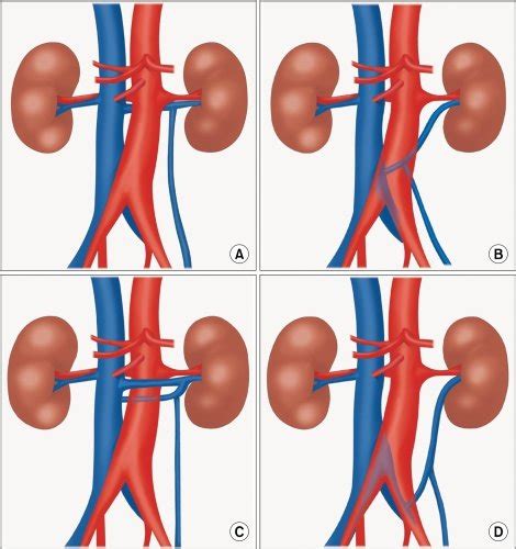 Schematic Illustration Of The Different Types Of Retroaortic Left Renal
