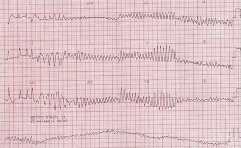 I cardioverted a patient in the field back in the 1980s with that presentation. EK1 04: Rhythm and Conduction Abnormalities (Part 2) at Touro University (NV) - StudyBlue