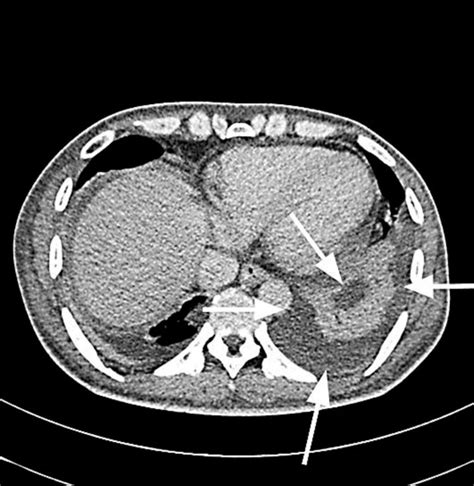 Ct Scan Of The Abdomen Showing Splenic Abscess Which Has Ruptured With