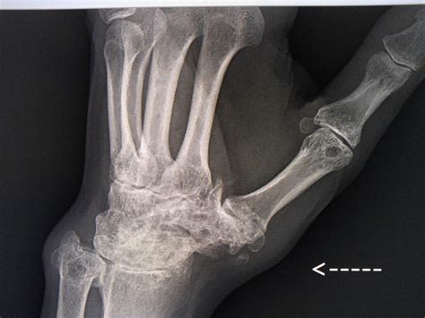25 Years Of Ra Damage To Wrist And Thumb Joints Rrheumatoid