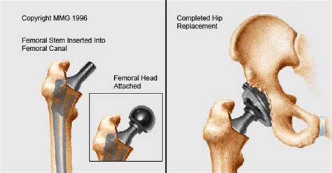 Hip Joint Replacement Surgery Cemented Uncemented Artificial