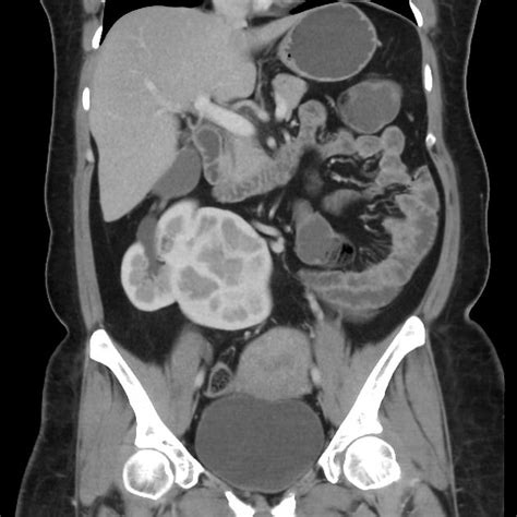 369 Best Images About Urogenital Radiology On Pinterest Render Image