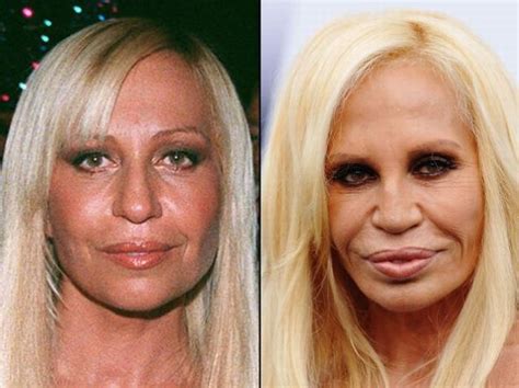 Celebrities Before And After A Plastic Surgery