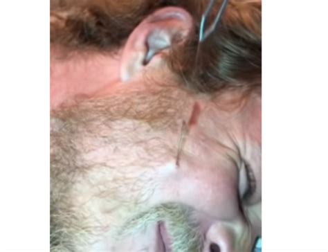 An ingrown hair is the main cause of a pilonidal cyst. guinness world record longest ingrown hair | New Pimple ...