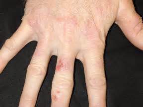 Irritant Contact Dermatitis Hand