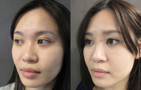 Asian Nose Surgery Before And After Photos Sydney Au
