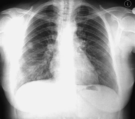 Benign Metastasizing Leiomyoma Presenting As Cavitating Lung Nodules