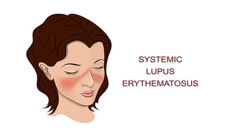 10 Early Signs Of Lupus That Every Woman Should Know Womenworking